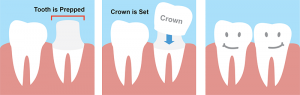 DentalCrowns